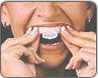 Etape 2 - Blanchiment dentaire